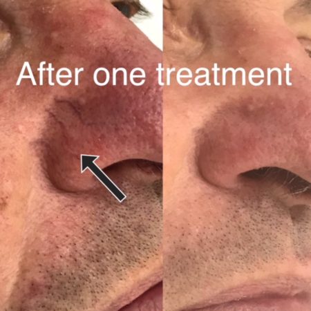 Before and after Fine Vein Removal