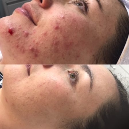 Before and after Personalised Acne Treatment