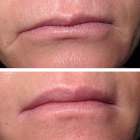 Before and after filler