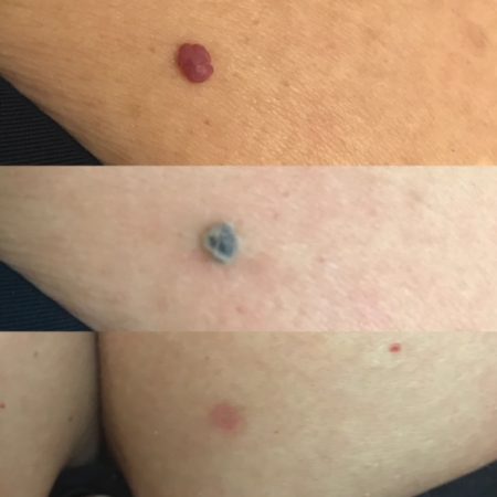 Before, immediately after and 6 weeks after Laser removal of Cherry Anginoma